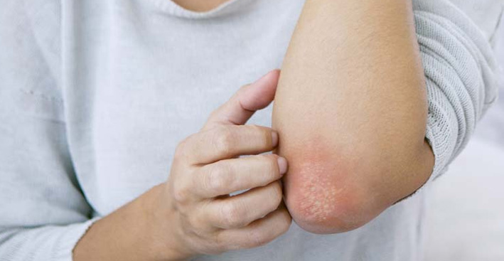 el-29-de-octubre-se-celebra-el-dia-mundial-de-la-psoriasis